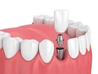 Dental Implant