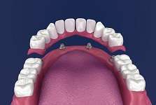 Dental Bridges